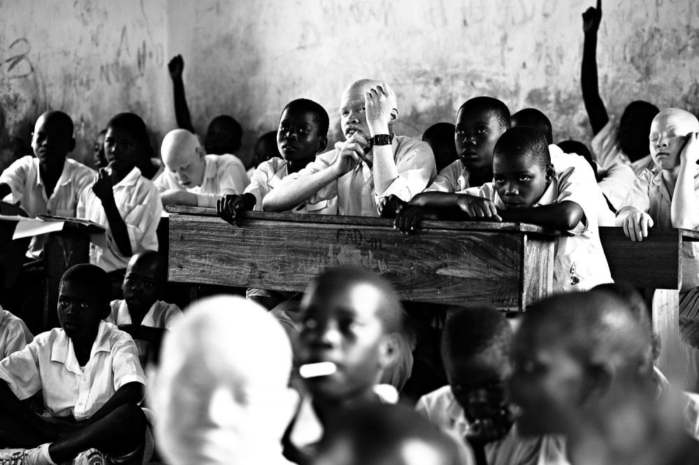 albino children tanzania